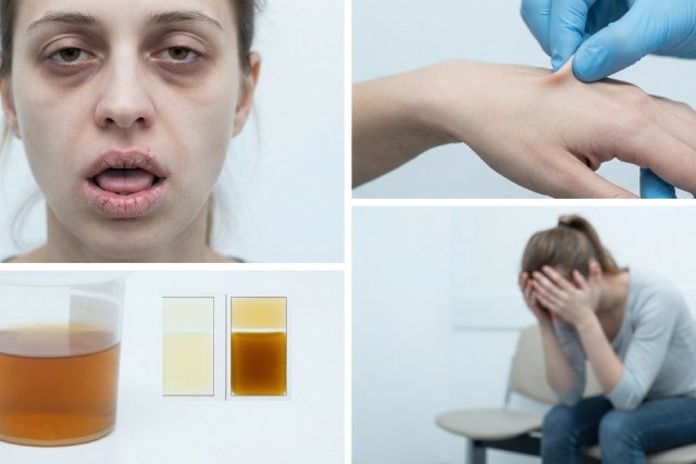 symptômes déshydratation